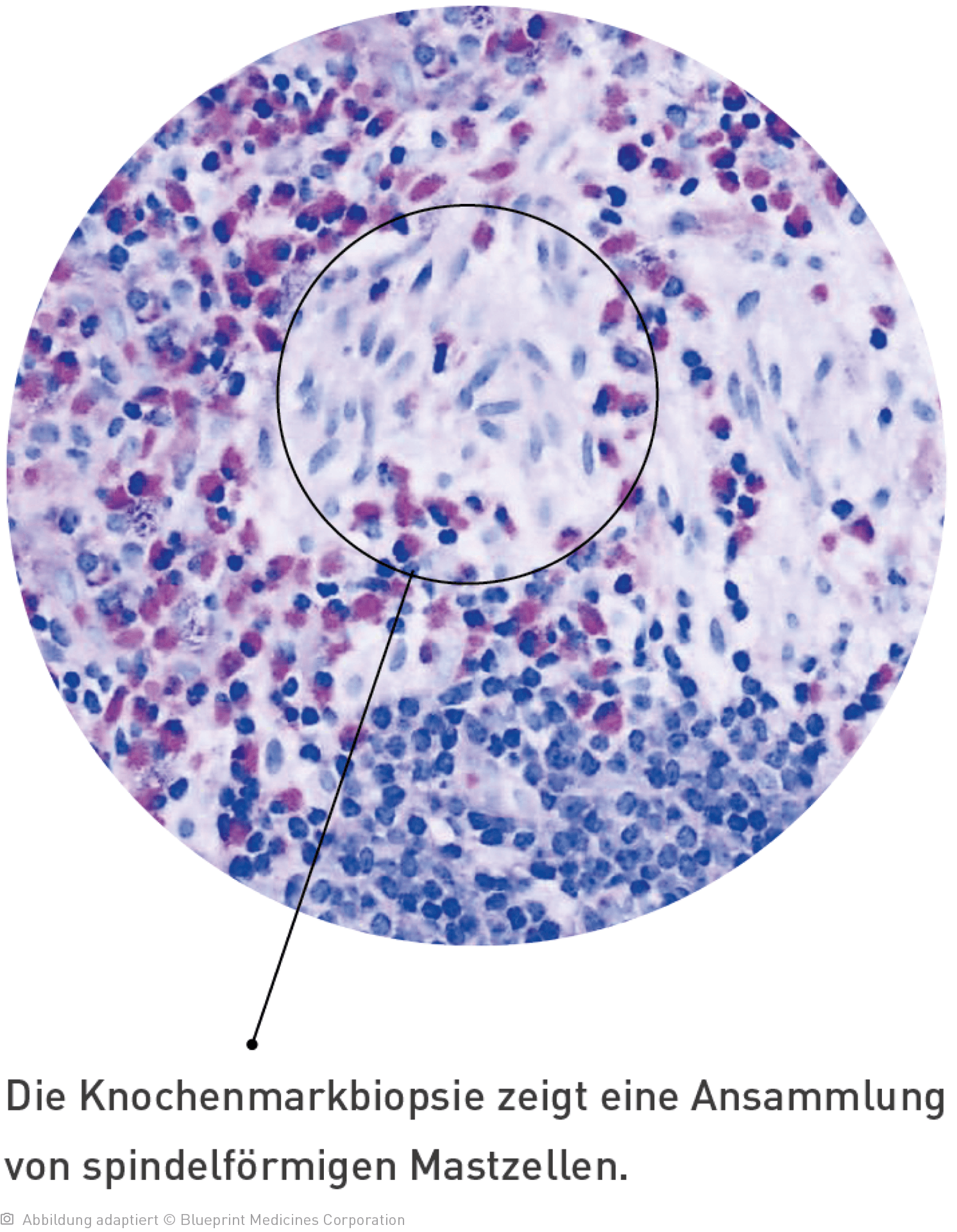 Aufnahme unter einem Mikroskop von einer Knochenmarkbiopsie zeigen eine Ansammlung von spindelförmigen Mastzellen.