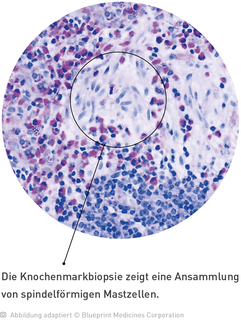 Aufnahme unter einem Mikroskop von einer Knochenmarkbiopsie zeigen eine Ansammlung von spindelförmigen Mastzellen.