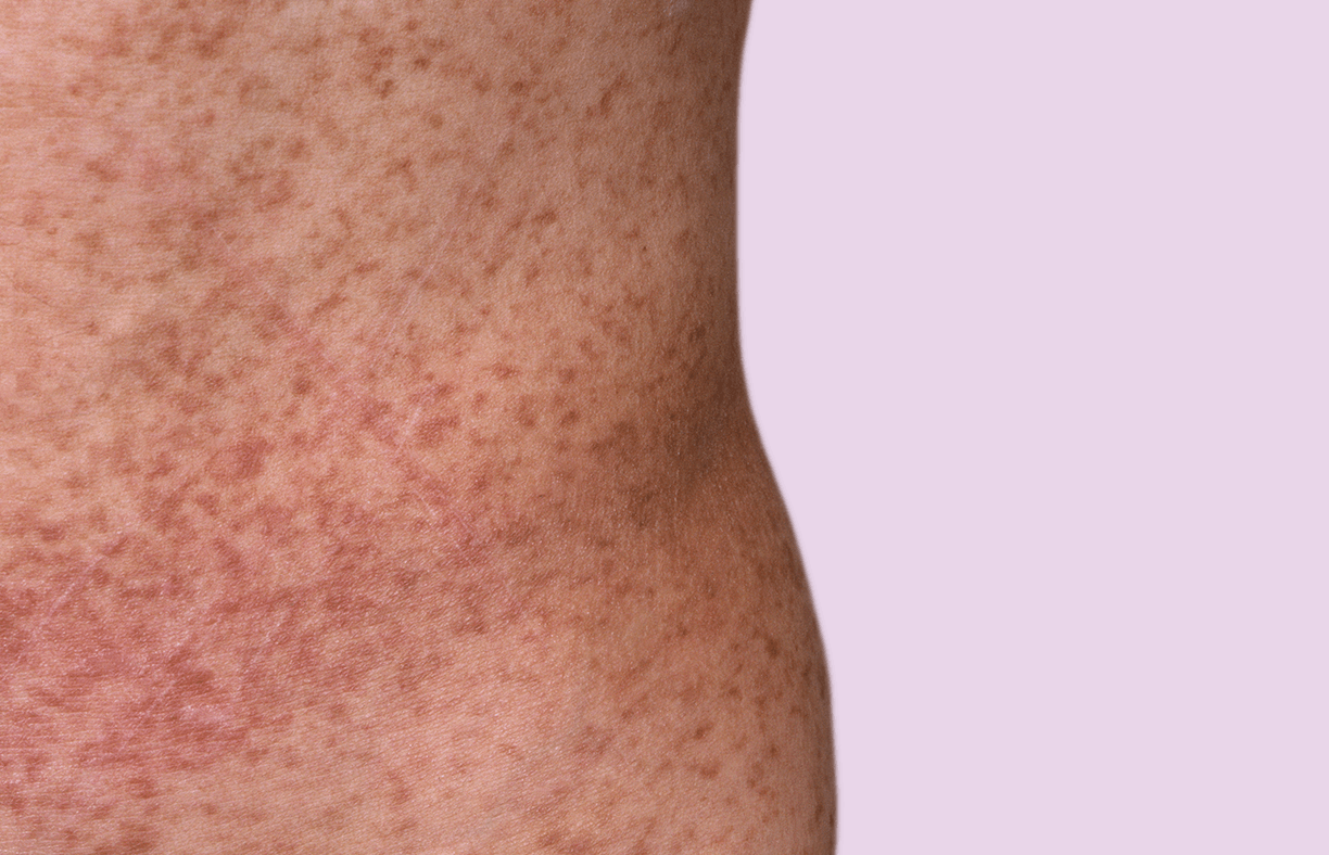 Foto von der Haut eines Patienten mit Mastozytose
