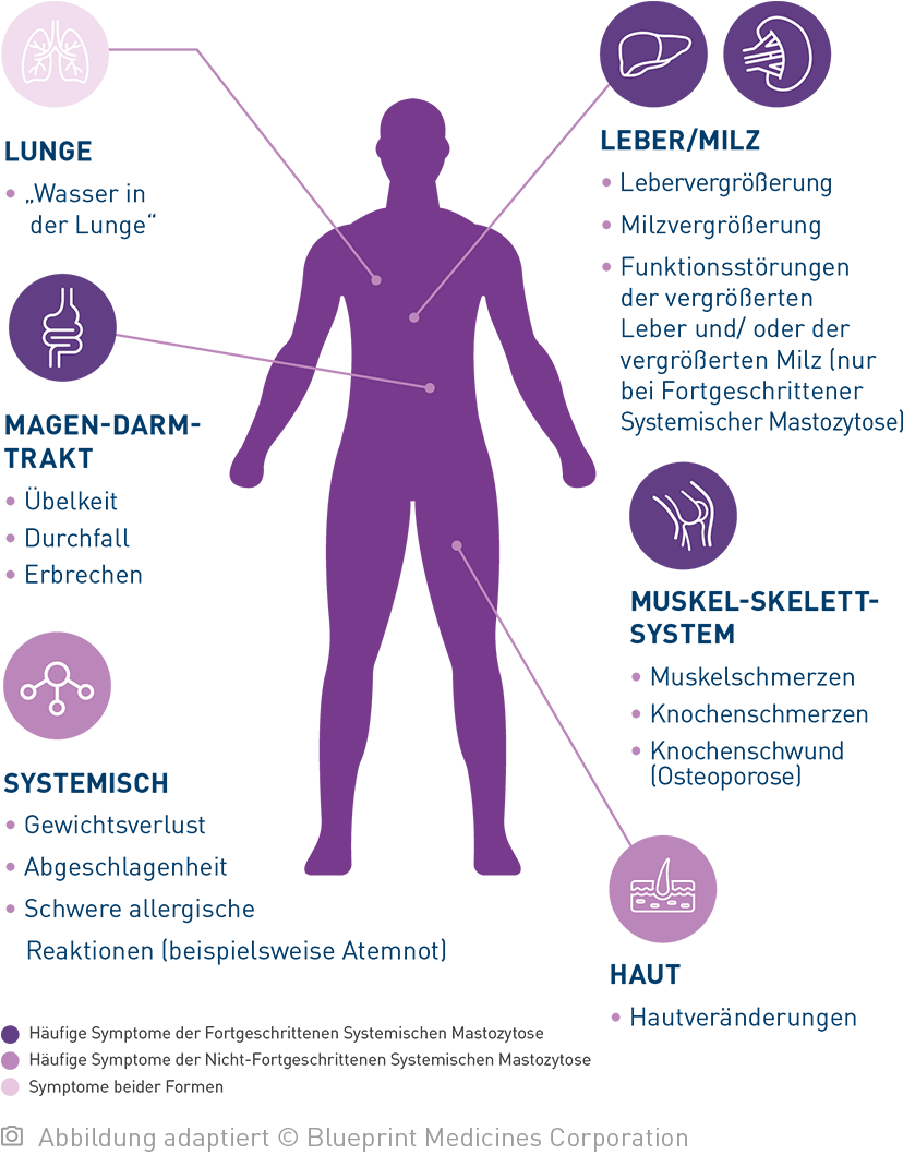 Vereinfachte Illustration eines menschlichen Körpers mit Hinweispfeilen auf die einzelnen Organe: Bei der Systemischen Mastozytose können unterschiedliche Symptome auftreten.