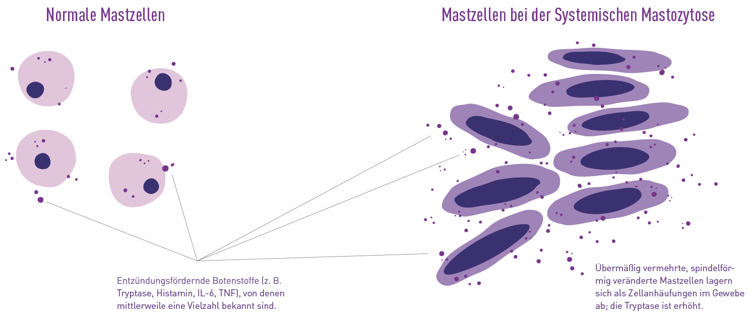 Grafik zur Verdeutlichung der Unterschiede zwischen normalen Mastzellen und spindelförmigen Mastzellen der Systemischen Mastozytose